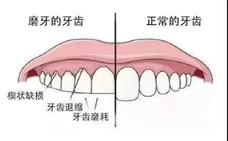 大门牙|门牙很大+龅牙怎么办？磨牙可以吗？